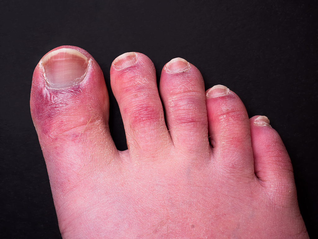 chilblains-on-toes-fingers-symptoms-and-treatment-health-sneak