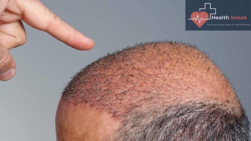 Hair transplant is a surgery that gives men and women coverage to those parts of the scalp where there is baldness.